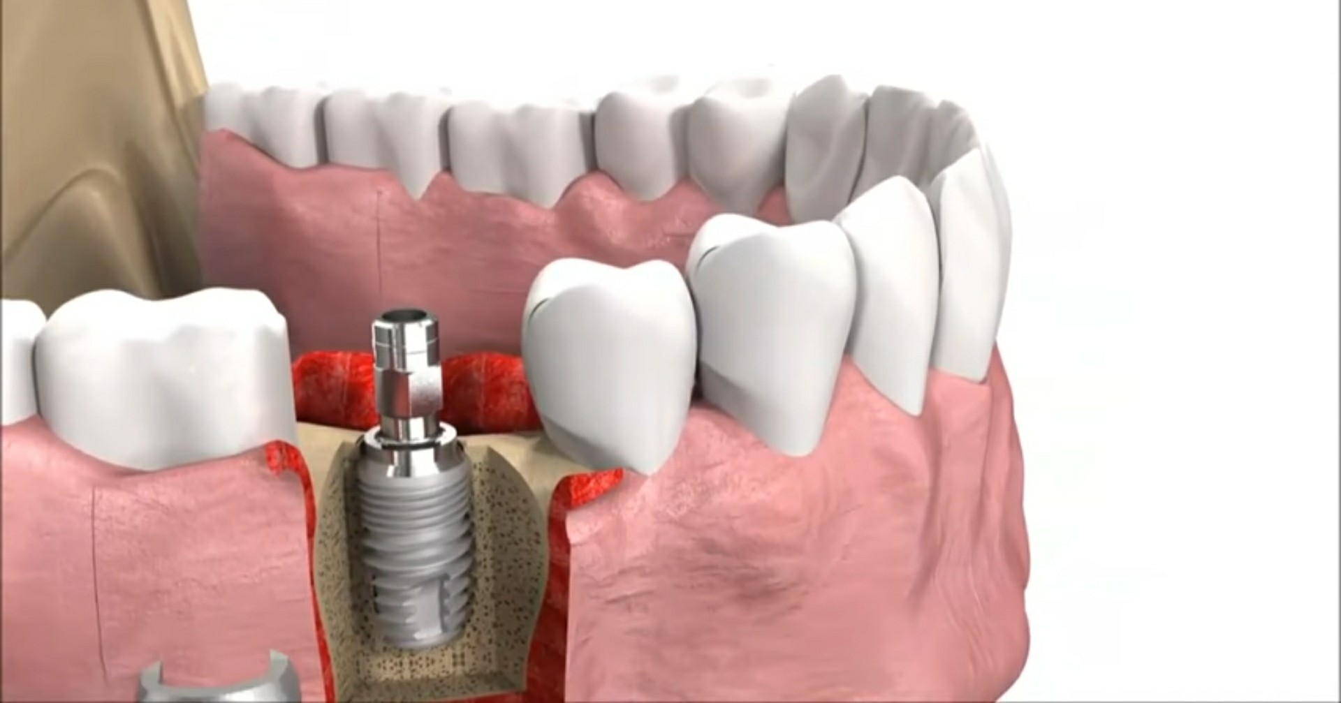 Ocjena najboljih klinika za dentalne implantate u Kazanu za 2025