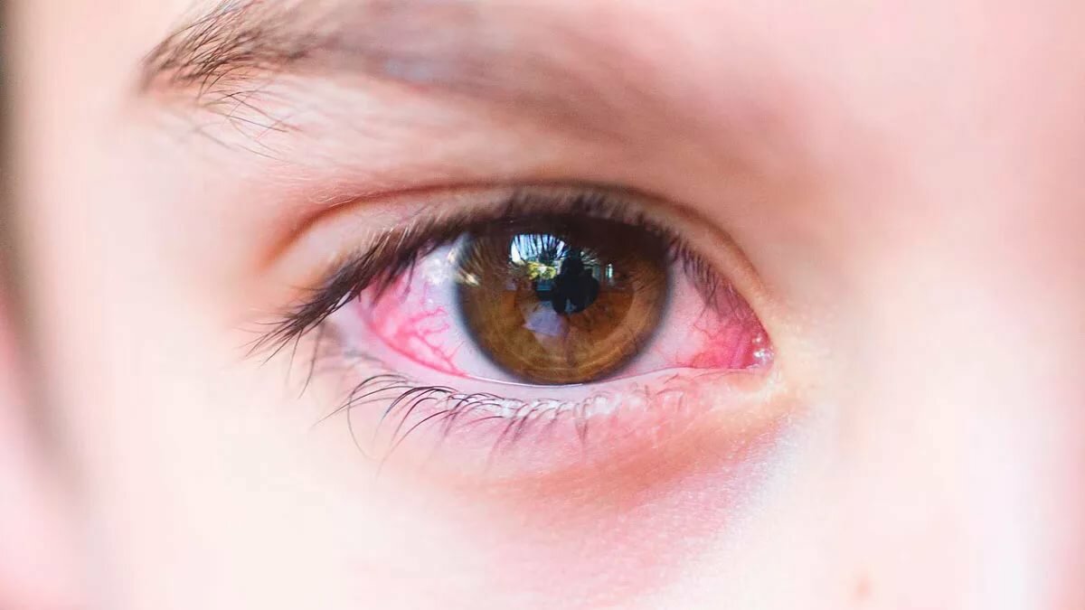 Rating of the best drops from conjunctivitis for 2025