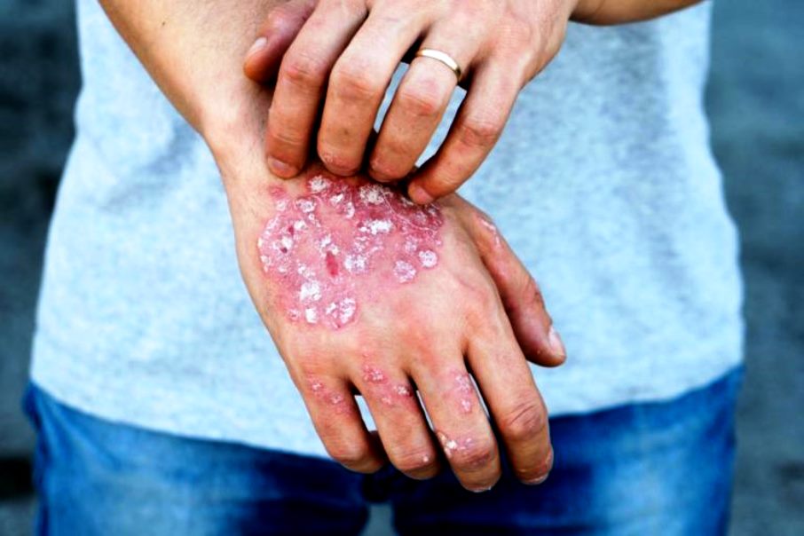 Rating of the best remedies for psoriasis for 2025