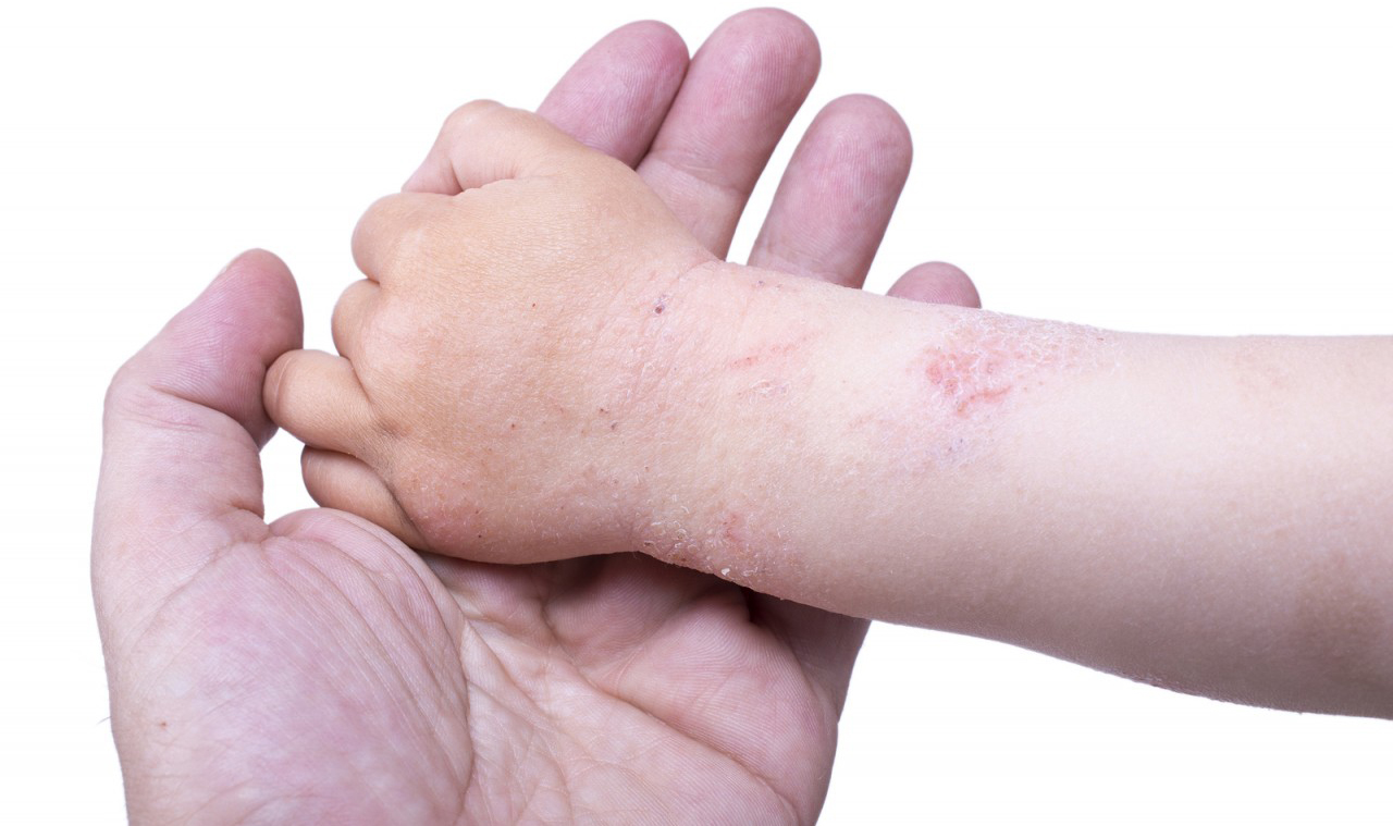 Ranking of the best creams for atopic dermatitis for 2025