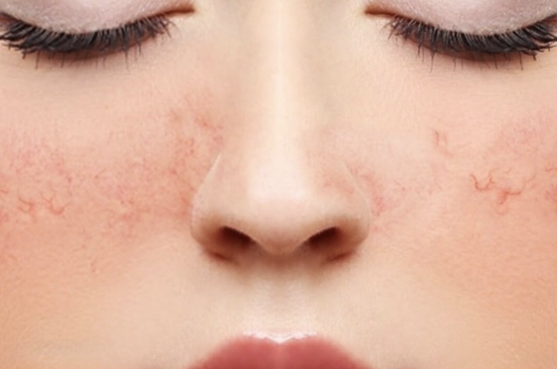 Rating of the best creams for rosacea for 2025