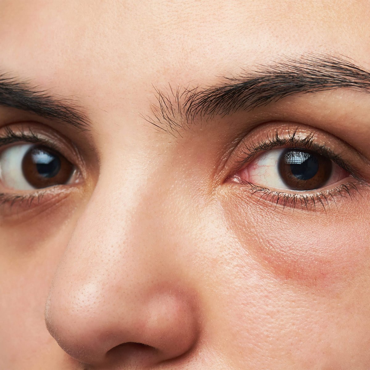 Ranking of the best remedies for dark circles under the eyes for 2025